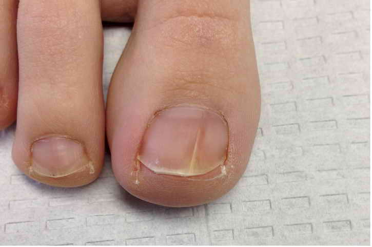 грибок на ногтях лечение