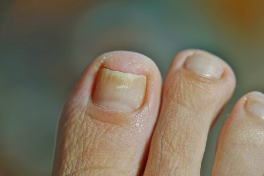 грибок на ногтях