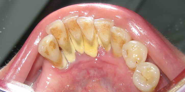 Зубные камни - удаление ореховой скорлупой